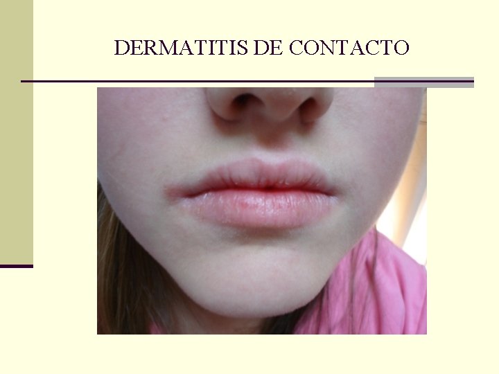 DERMATITIS DE CONTACTO DERMATITIS DE CONTACTO