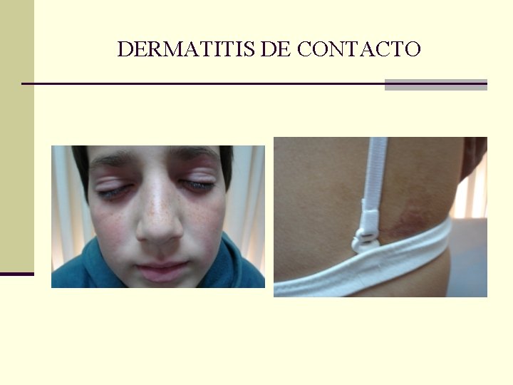 DERMATITIS DE CONTACTO DERMATITIS DE CONTACTO