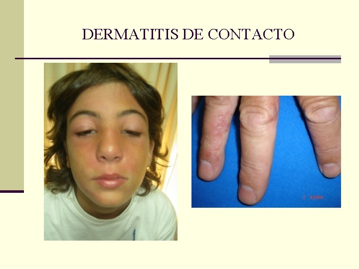 DERMATITIS DE CONTACTO DERMATITIS DE CONTACTO