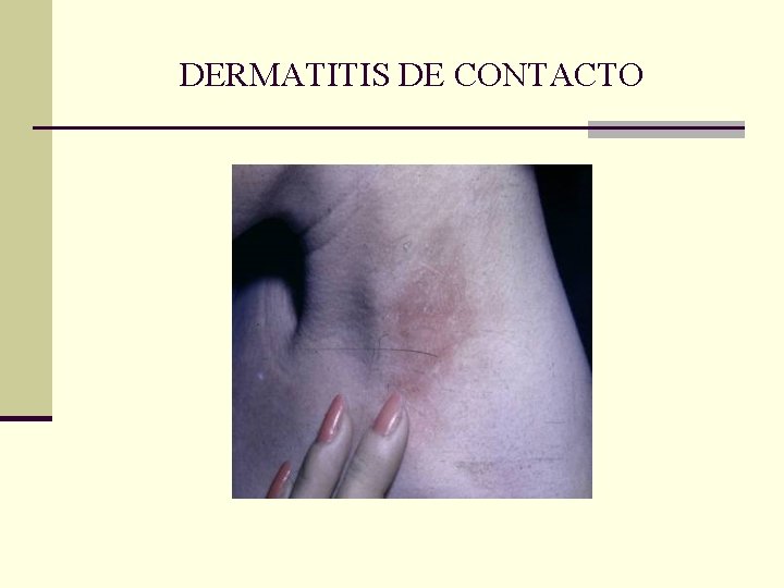 DERMATITIS DE CONTACTO DERMATITIS DE CONTACTO
