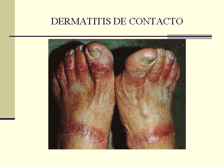 DERMATITIS DE CONTACTO DERMATITIS DE CONTACTO