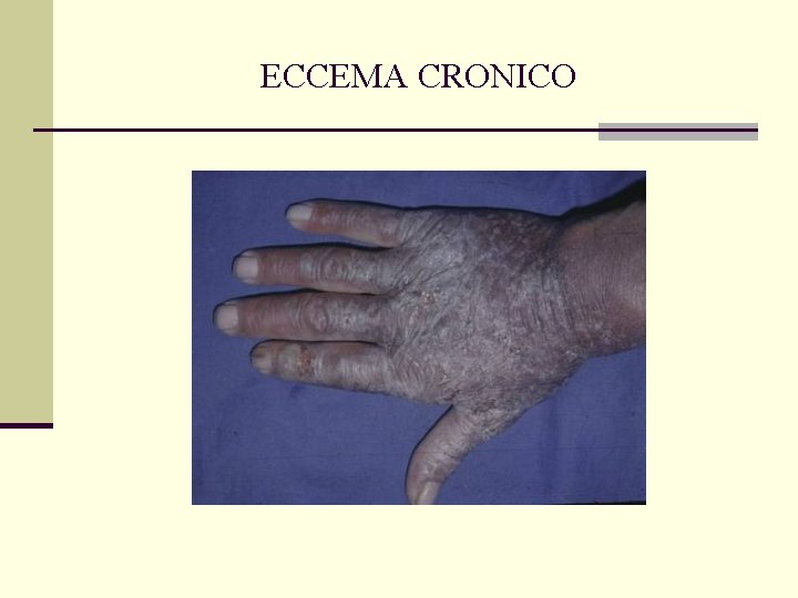 ECCEMA CRONICO ECCEMA CRONICO