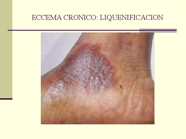 ECCEMA CRONICO: LIQUENIFICACION ECCEMA CRONICO: LIQUENIFICACION