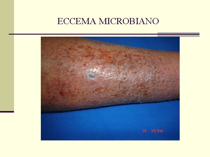 ECCEMA MICROBIANO ECCEMA MICROBIANO