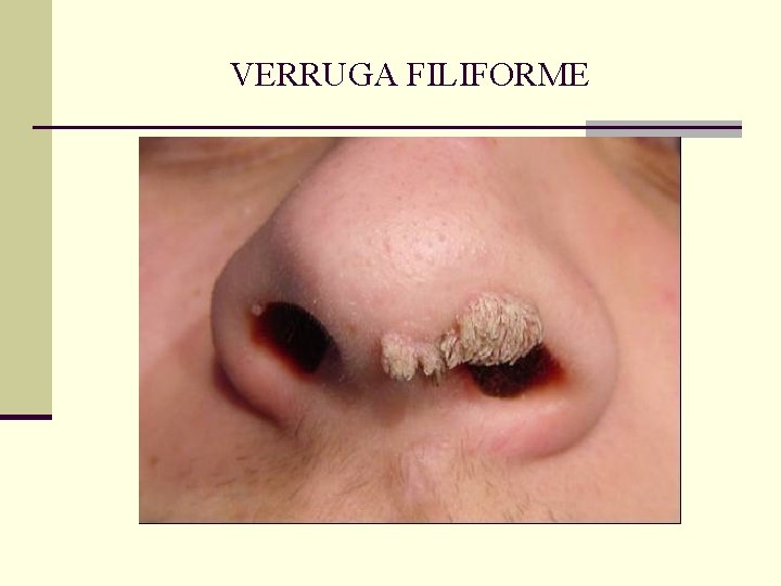 VERRUGA FILIFORME VERRUGA FILIFORME
