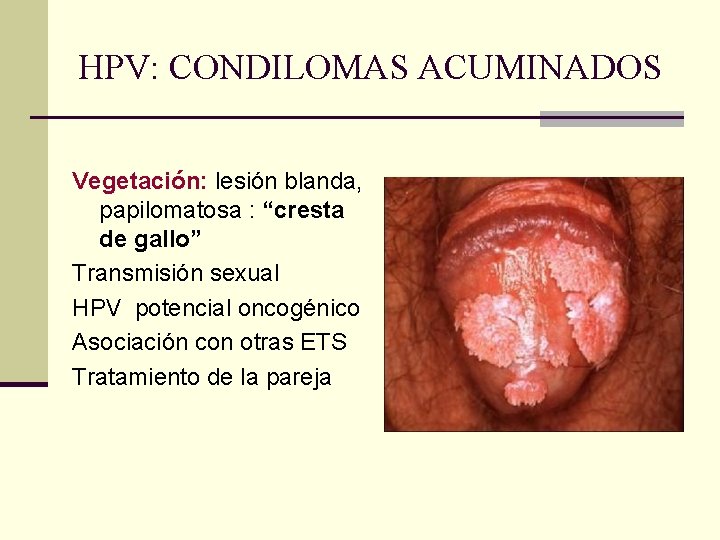 HPV: CONDILOMAS ACUMINADOS Vegetación: lesión blanda, papilomatosa : “cresta de gallo” Transmisión sexual HPV HPV: CONDILOMAS ACUMINADOS Vegetación: lesión blanda, papilomatosa : “cresta de gallo” Transmisión sexual HPV