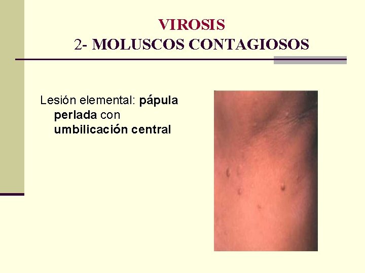 VIROSIS 2 - MOLUSCOS CONTAGIOSOS Lesión elemental: pápula perlada con umbilicación central VIROSIS 2 - MOLUSCOS CONTAGIOSOS Lesión elemental: pápula perlada con umbilicación central