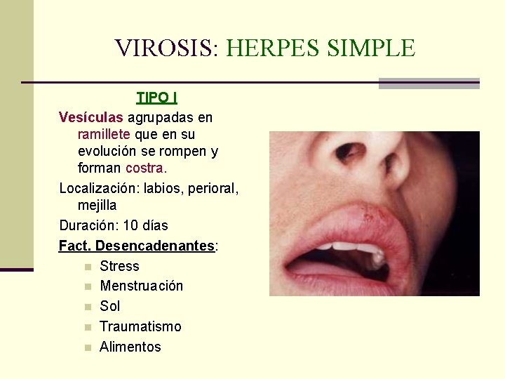 VIROSIS: HERPES SIMPLE TIPO I Vesículas agrupadas en ramillete que en su evolución se VIROSIS: HERPES SIMPLE TIPO I Vesículas agrupadas en ramillete que en su evolución se