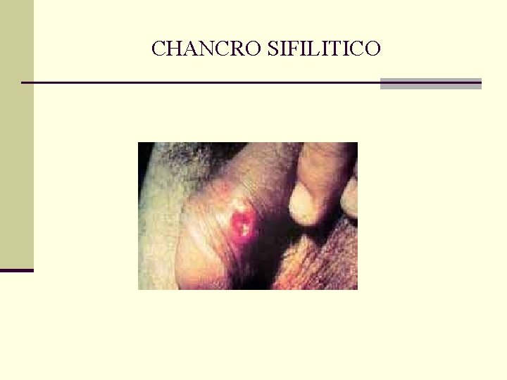 CHANCRO SIFILITICO CHANCRO SIFILITICO