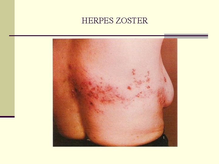 HERPES ZOSTER HERPES ZOSTER