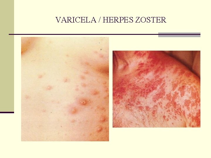 VARICELA / HERPES ZOSTER VARICELA / HERPES ZOSTER