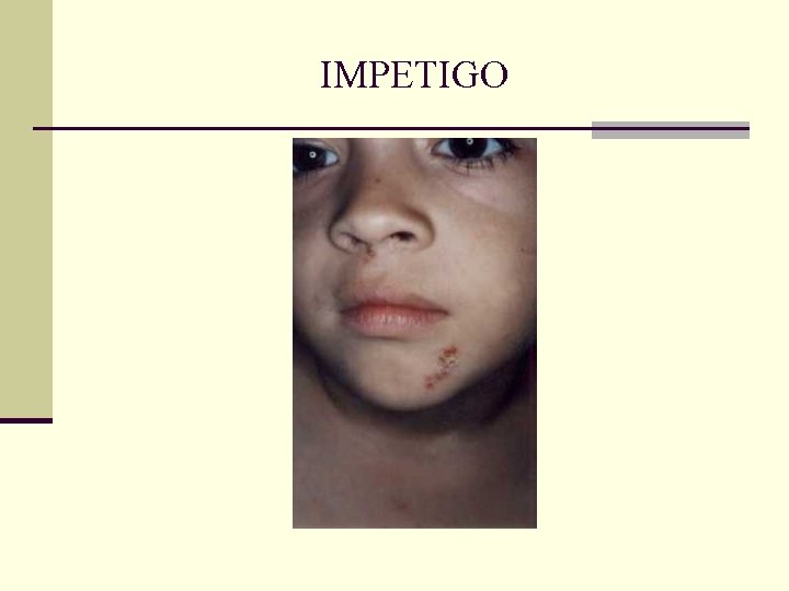 IMPETIGO IMPETIGO