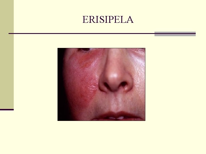 ERISIPELA ERISIPELA