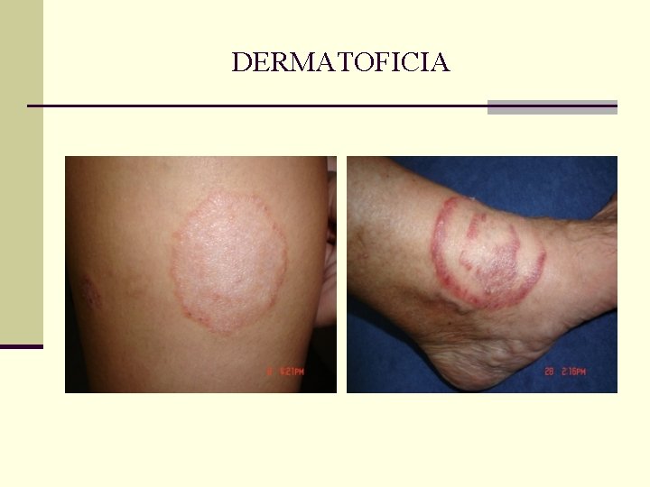 DERMATOFICIA DERMATOFICIA