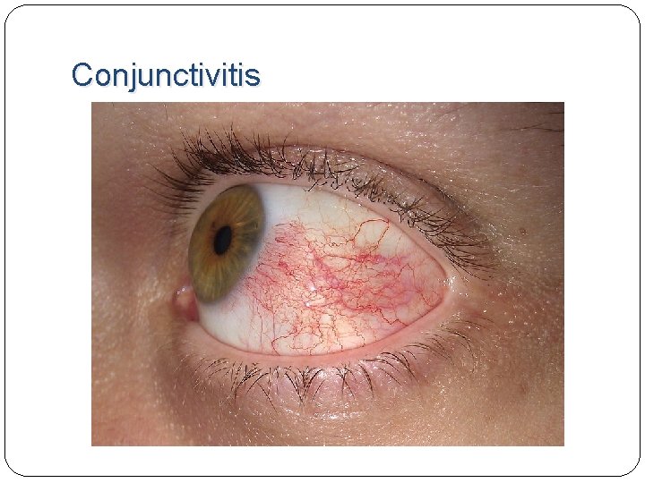 Conjunctivitis Conjunctivitis