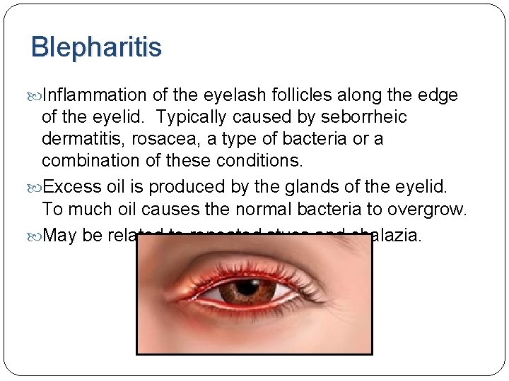 Blepharitis Inflammation of the eyelash follicles along the edge of the eyelid. Typically caused Blepharitis Inflammation of the eyelash follicles along the edge of the eyelid. Typically caused