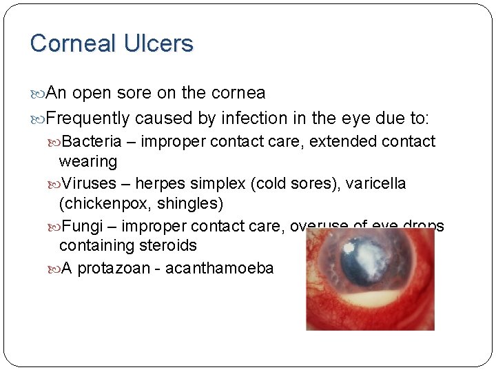 Corneal Ulcers An open sore on the cornea Frequently caused by infection in the Corneal Ulcers An open sore on the cornea Frequently caused by infection in the