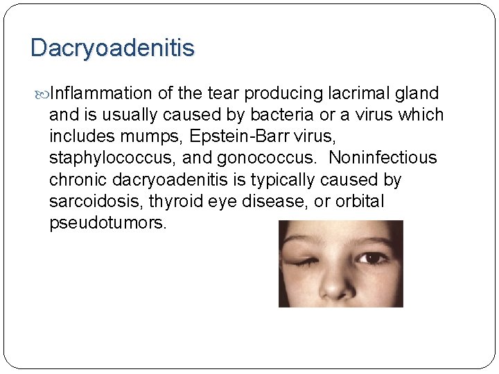 Dacryoadenitis Inflammation of the tear producing lacrimal gland is usually caused by bacteria or Dacryoadenitis Inflammation of the tear producing lacrimal gland is usually caused by bacteria or