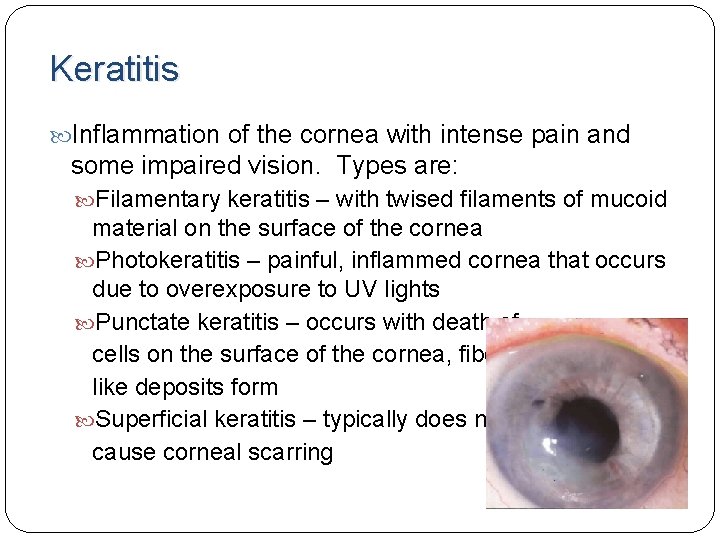 Keratitis Inflammation of the cornea with intense pain and some impaired vision. Types are: Keratitis Inflammation of the cornea with intense pain and some impaired vision. Types are: