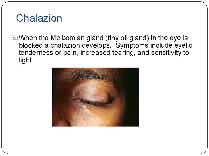 Chalazion When the Meibomian gland (tiny oil gland) in the eye is blocked a Chalazion When the Meibomian gland (tiny oil gland) in the eye is blocked a