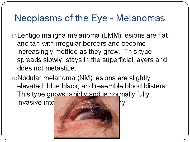 Neoplasms of the Eye - Melanomas Lentigo maligna melanoma (LMM) lesions are flat and Neoplasms of the Eye - Melanomas Lentigo maligna melanoma (LMM) lesions are flat and