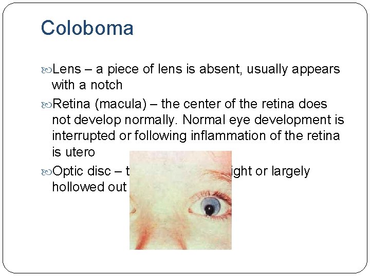 Coloboma Lens – a piece of lens is absent, usually appears with a notch Coloboma Lens – a piece of lens is absent, usually appears with a notch