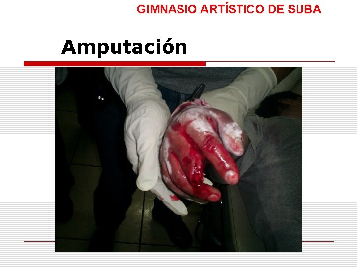 GIMNASIO ARTÍSTICO DE SUBA Amputación 