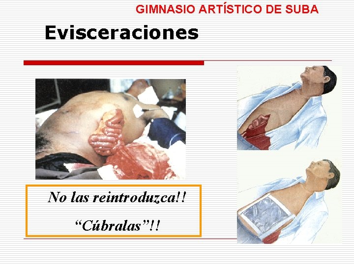 GIMNASIO ARTÍSTICO DE SUBA Evisceraciones No las reintroduzca!! “Cúbralas”!! 
