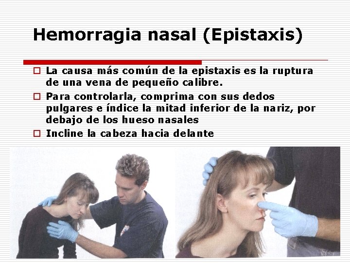 Hemorragia nasal (Epistaxis) o La causa más común de la epistaxis es la ruptura