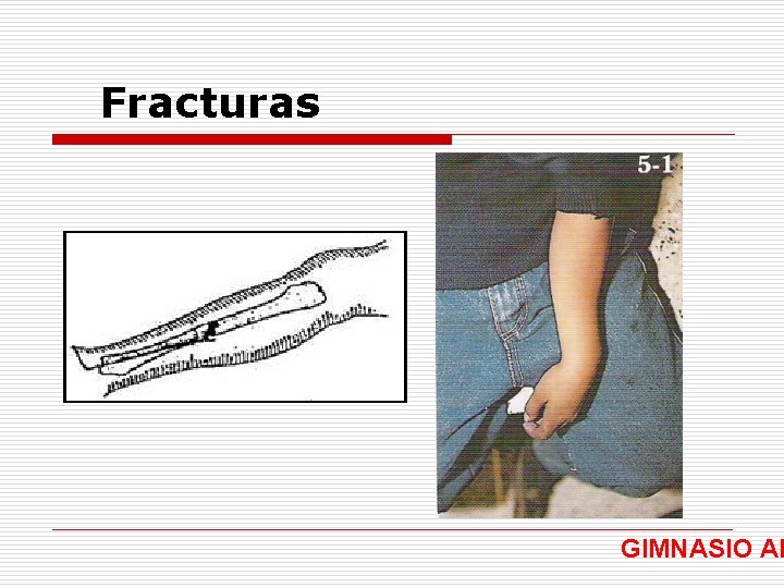 Fracturas GIMNASIO AR 