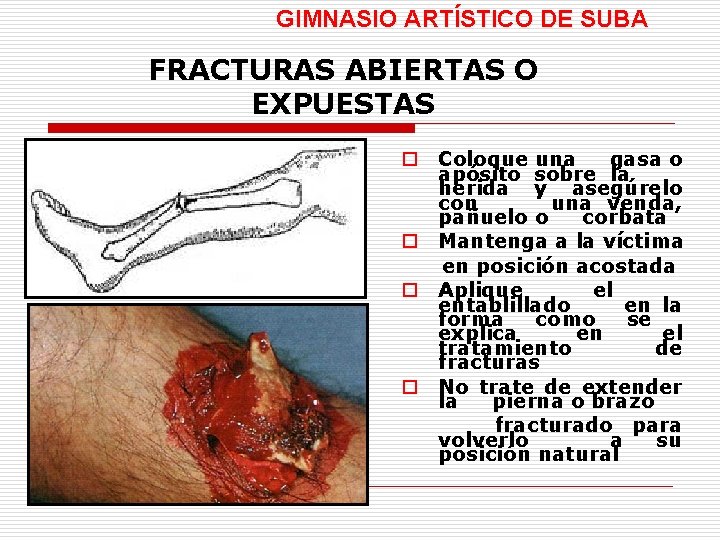 GIMNASIO ARTÍSTICO DE SUBA FRACTURAS ABIERTAS O EXPUESTAS o Coloque una gasa o apósito