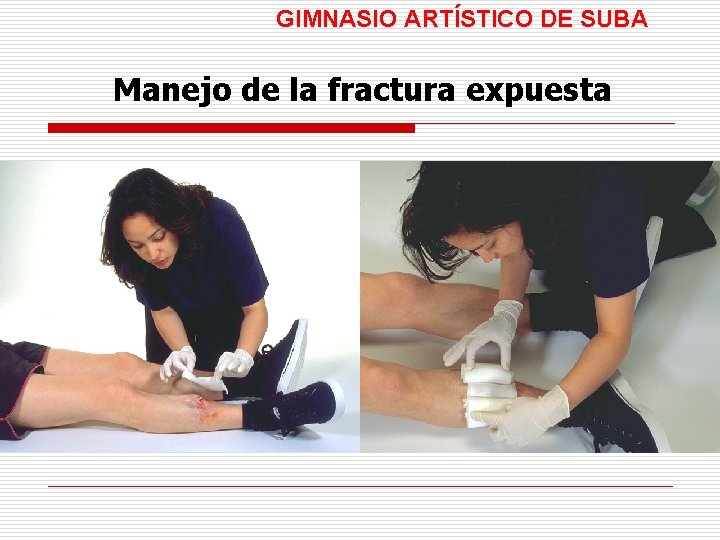 GIMNASIO ARTÍSTICO DE SUBA Manejo de la fractura expuesta 