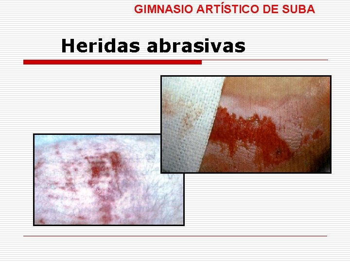 GIMNASIO ARTÍSTICO DE SUBA Heridas abrasivas 