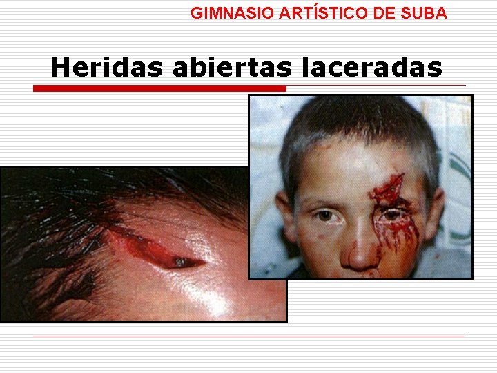 GIMNASIO ARTÍSTICO DE SUBA Heridas abiertas laceradas 