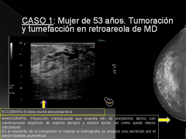 CASO 1: Mujer de 53 años. Tumoración y tumefacción en retroareola de MD ECOGRAFÍA: