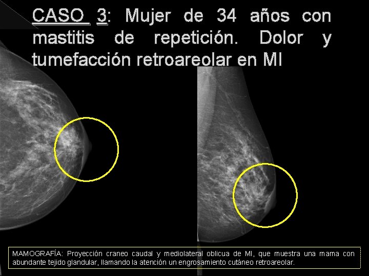 CASO 3: Mujer de 34 años con mastitis de repetición. Dolor y tumefacción retroareolar