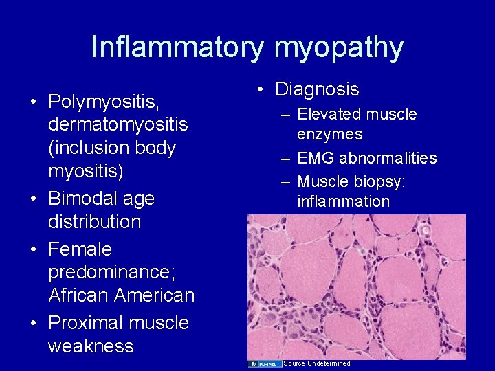 Inflammatory myopathy • Polymyositis, dermatomyositis (inclusion body myositis) • Bimodal age distribution • Female