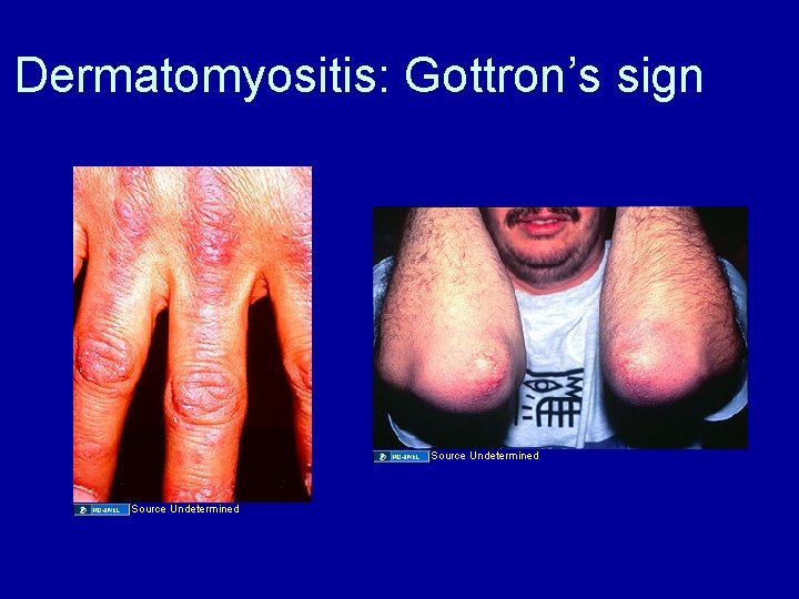 Dermatomyositis: Gottron’s sign Source Undetermined 