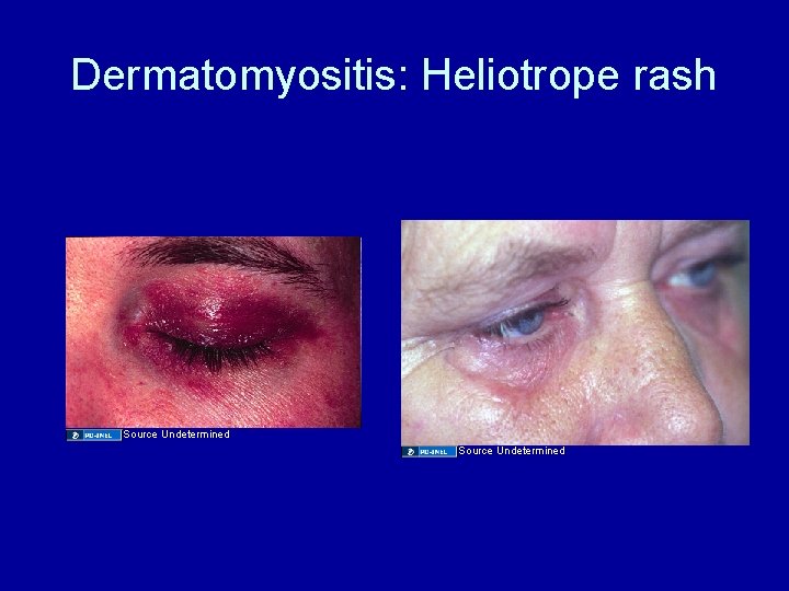 Dermatomyositis: Heliotrope rash Source Undetermined 