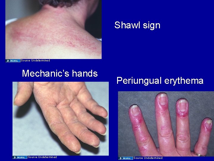 Shawl sign Source Undetermined Mechanic’s hands Source Undetermined Periungual erythema Source Undetermined 