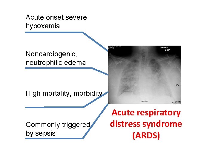 Acute onset severe hypoxemia Noncardiogenic, neutrophilic edema High mortality, morbidity Commonly triggered by sepsis