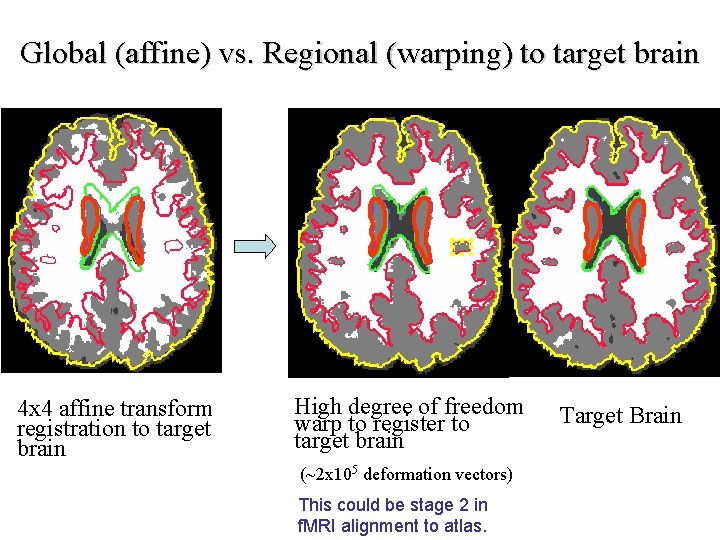 Global (affine) vs. Regional (warping) to target brain 4 x 4 affine transform registration