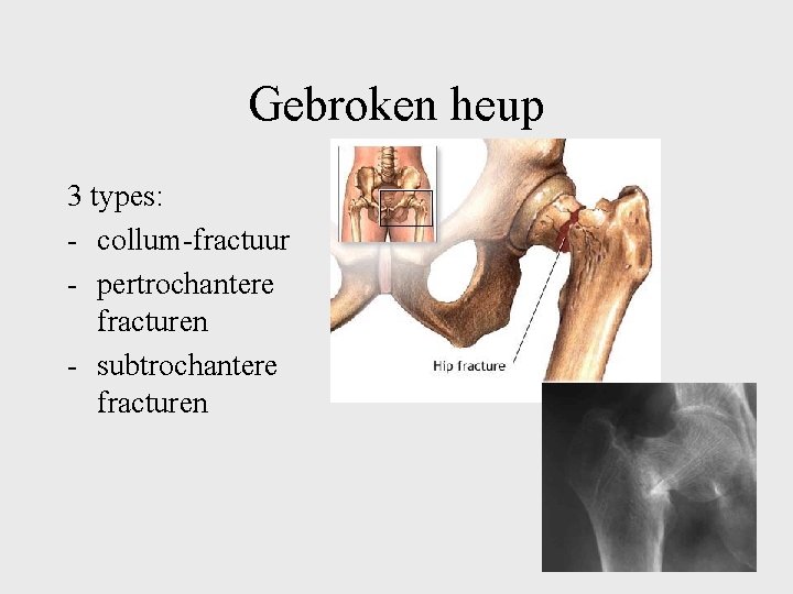 Gebroken heup 3 types: - collum-fractuur - pertrochantere fracturen - subtrochantere fracturen 