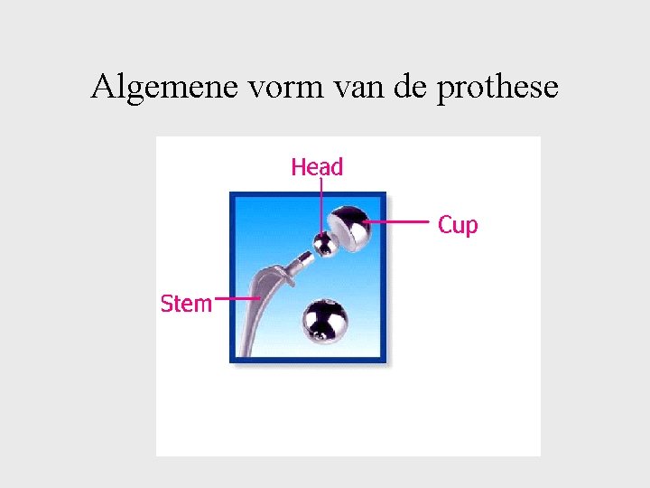 Algemene vorm van de prothese 