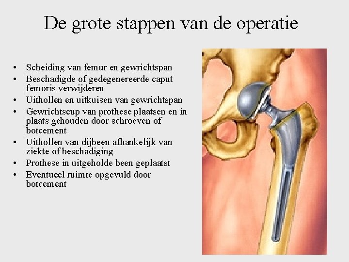 De grote stappen van de operatie • Scheiding van femur en gewrichtspan • Beschadigde