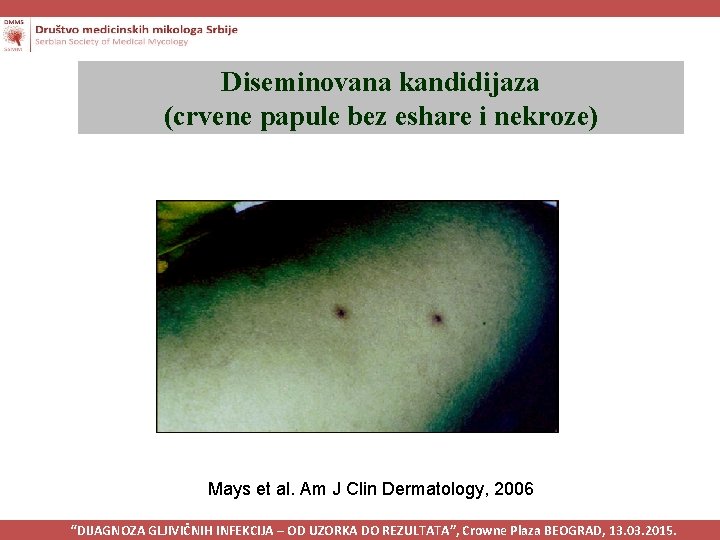 Diseminovana kandidijaza (crvene papule bez eshare i nekroze) Mays et al. Am J Clin