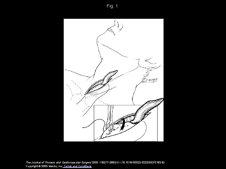 Fig. 1 The Journal of Thoracic and Cardiovascular Surgery 2000 119277 -288 DOI: (10.