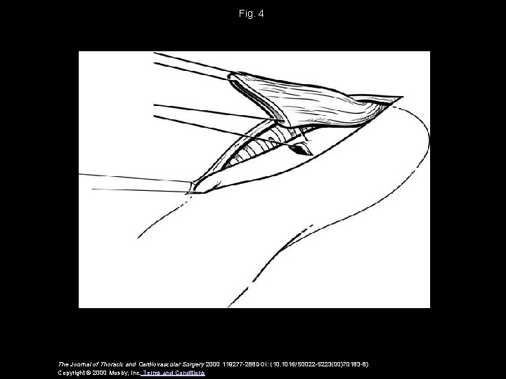 Fig. 4 The Journal of Thoracic and Cardiovascular Surgery 2000 119277 -288 DOI: (10.