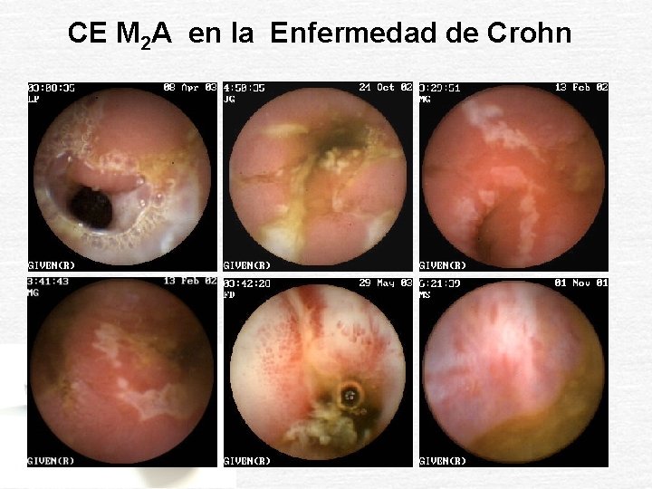 CE M 2 A en la Enfermedad de Crohn 