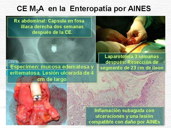 CE M 2 A en la Enteropatía por AINES Rx abdominal: Cápsula en fosa